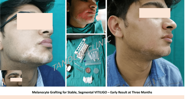vitiligo treatment in Delhi