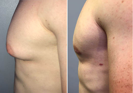 Male Breast Reduction surgery in Delhi