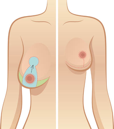 Best Breast Reduction Surgery in Delhi For Saggy Breast