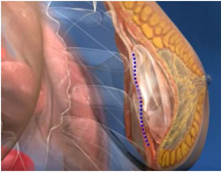 breast-enlargement-in-delhi