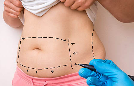 tummy tuck in Delhi