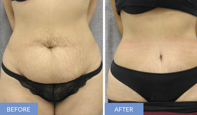 abdominoplasty in Delhi