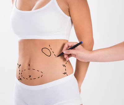 Best Liposuction in Delhi For Fat Reduction - Dr Ashok Tandon