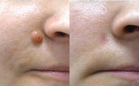 Best Mole Removal in Rohini, Delhi With Laser - Dr Ashok Tandon