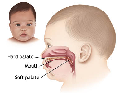 cleft-lip-treatment-in-delhi