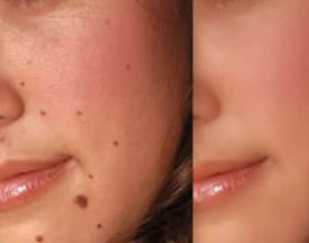 mole removal treatment in Ashok Vihar