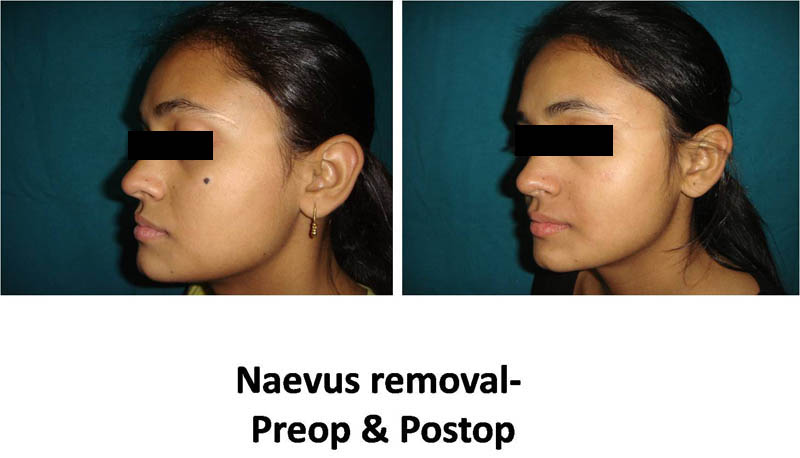 Best Mole Removal in Nangloi - Dr Ashok Tandon