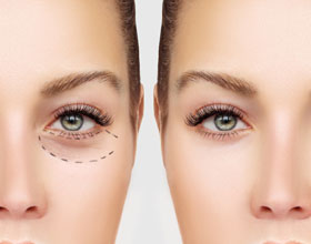 Best Blepharoplasty in Delhi, Eyelid Surgery in Delhi - Dr Ashok Tandon