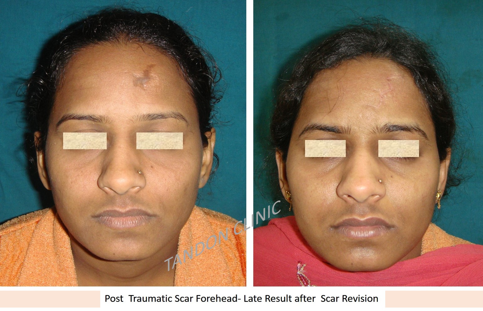 Scar Treatment/Removal in Nangloi - Plastic Surgeon in Delhi