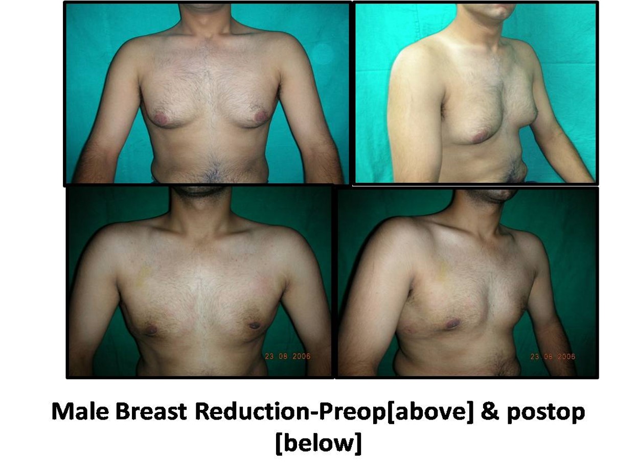 Best Male Breast Reduction Surgery in Delhi, Rohini- Dr Ashok Tandon