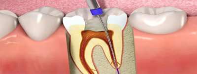 Root Canal