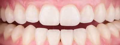 Depigmentation Of Gums