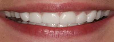Dental Veneer and Thinner
