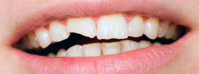 Treatment of Fractured, Broken Tooth