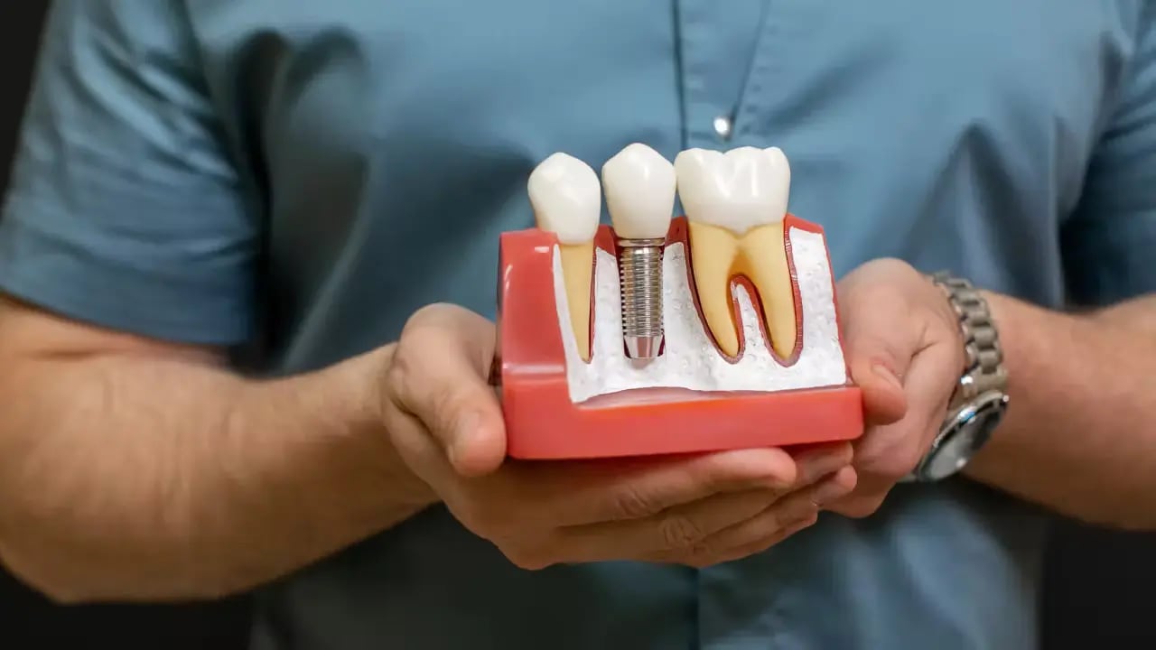 Dental Implant Recovery Tips