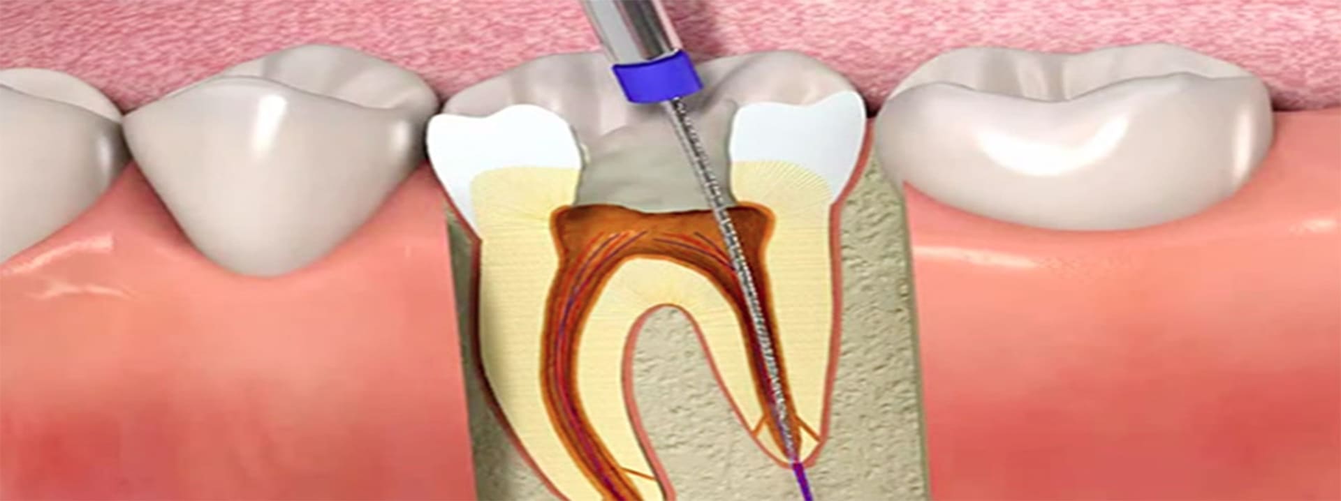 Root Canal