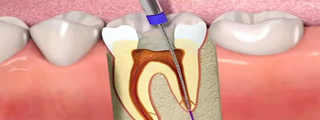 Root Canal Treatment