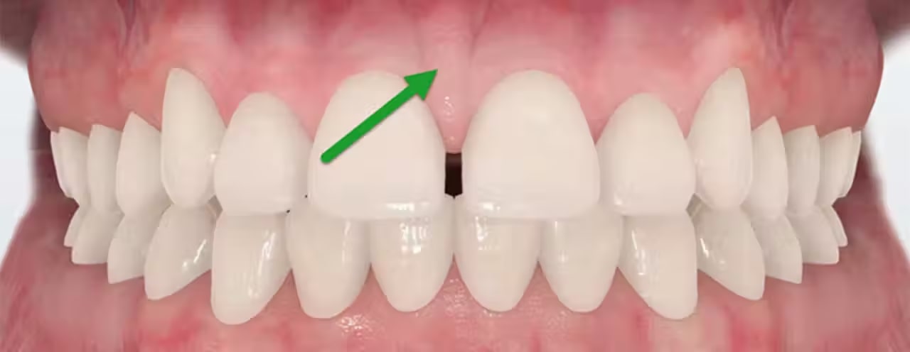 Frenectomy and Frenuloplasty