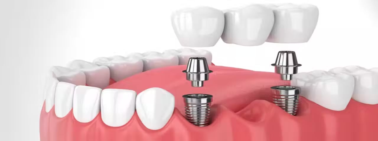 Dental Implant