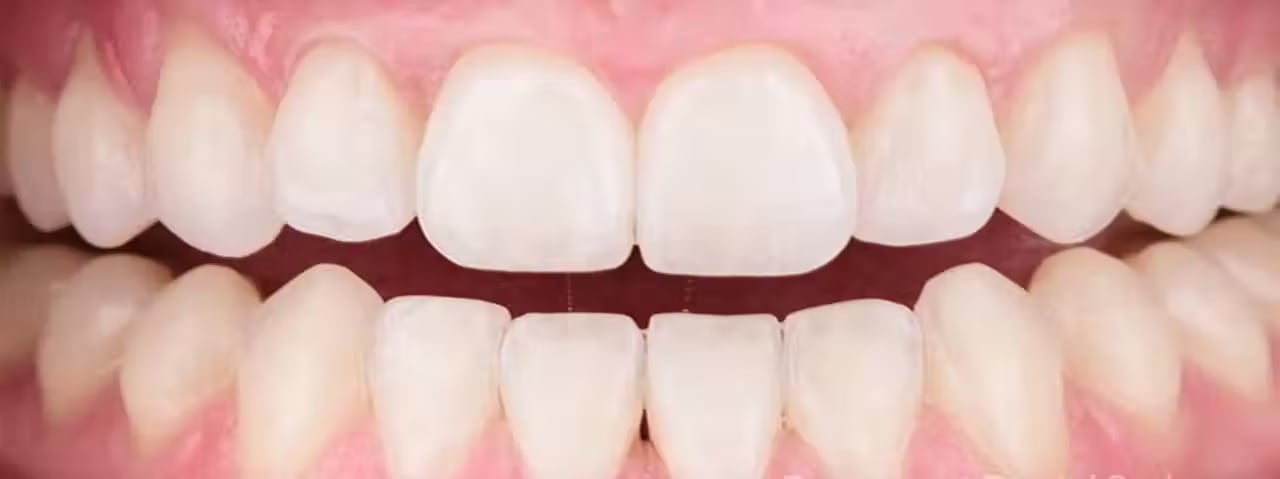 Depigmentation Of Gums