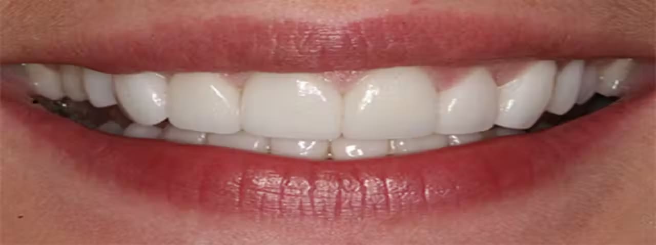 Dental Veneer and Thinner