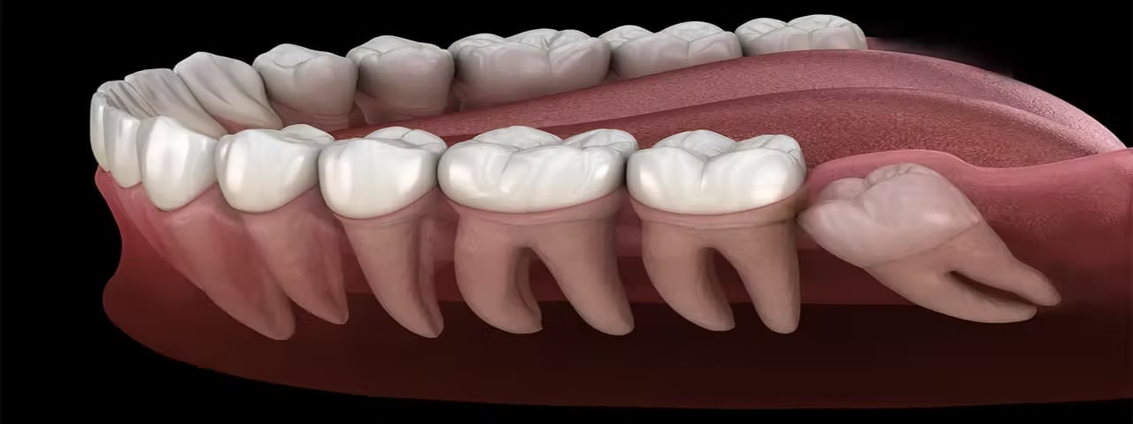 Wisdom Tooth Surgery