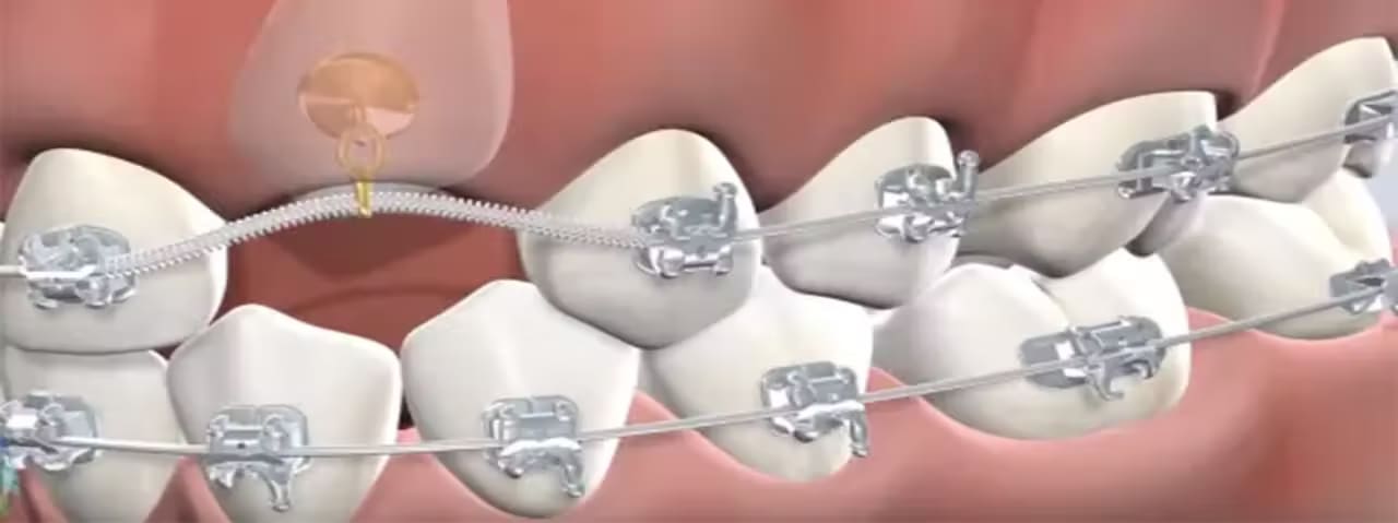 Surgical Exposure of Impacted/Timely Non-Erupted Front Tooth/Teeth