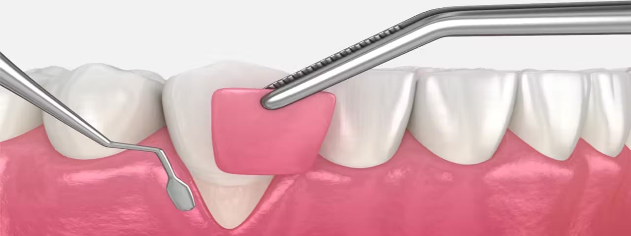 Gum Surgery & Periodontal Surgery