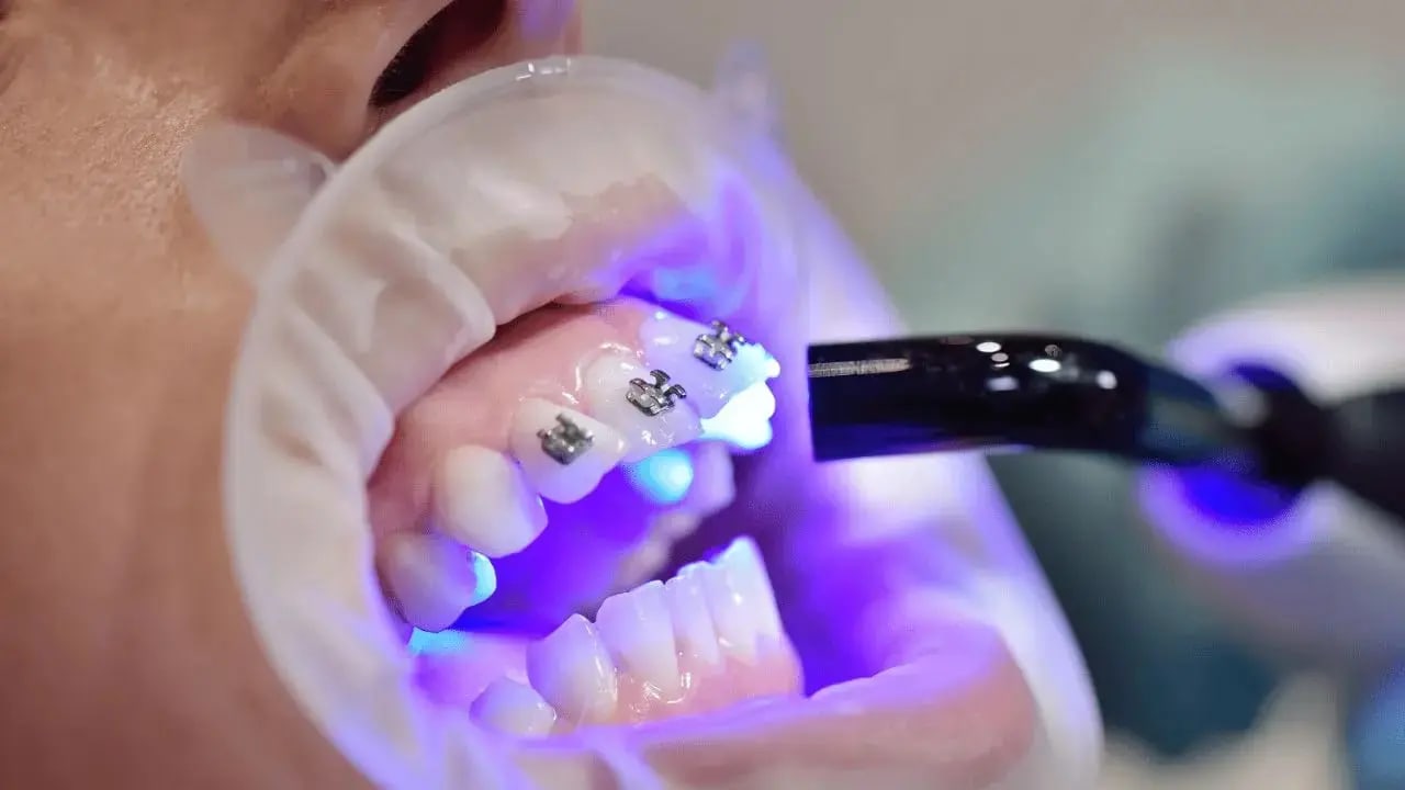 Root Canal Treatment Demo