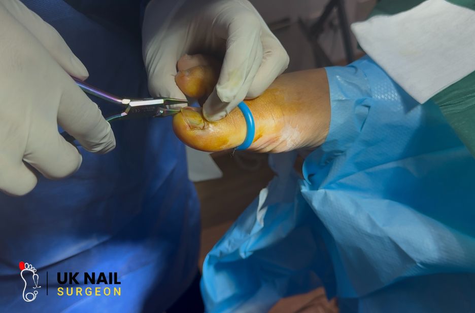 Ingrown Toenails: Expert Care for Quick, Pain-Free Relief