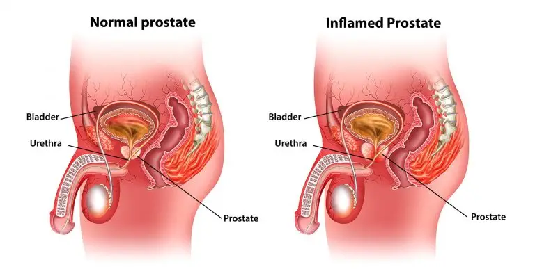 Understanding Enlarged Prostate Pain Causes, Symptoms, and Relief