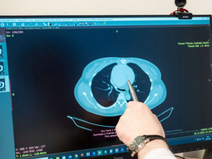 Челябинские кардиохирурги удалили гигантскую аневризму аорты маме близнецов