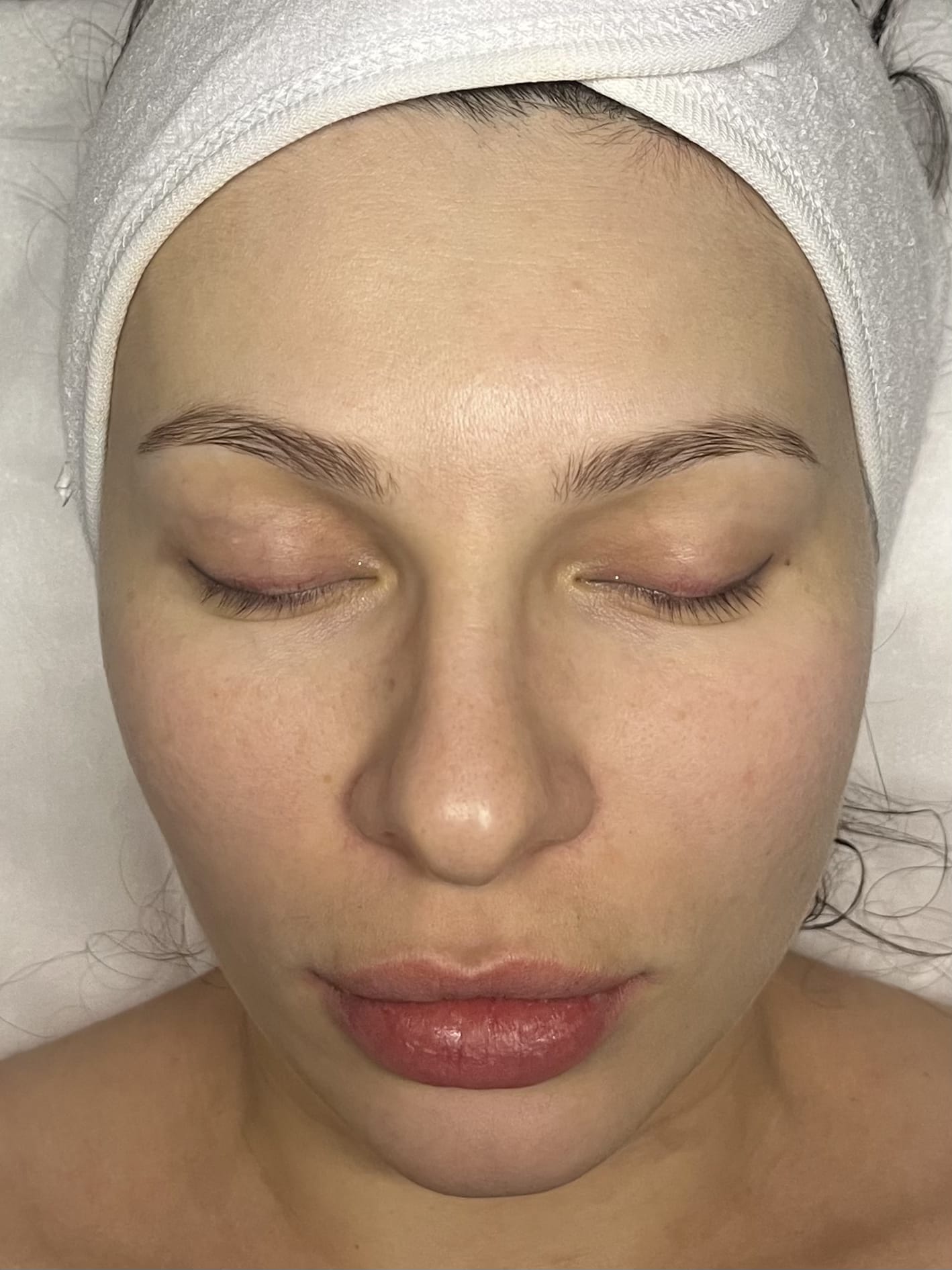 Before post-winter reset seasonal facial treatment