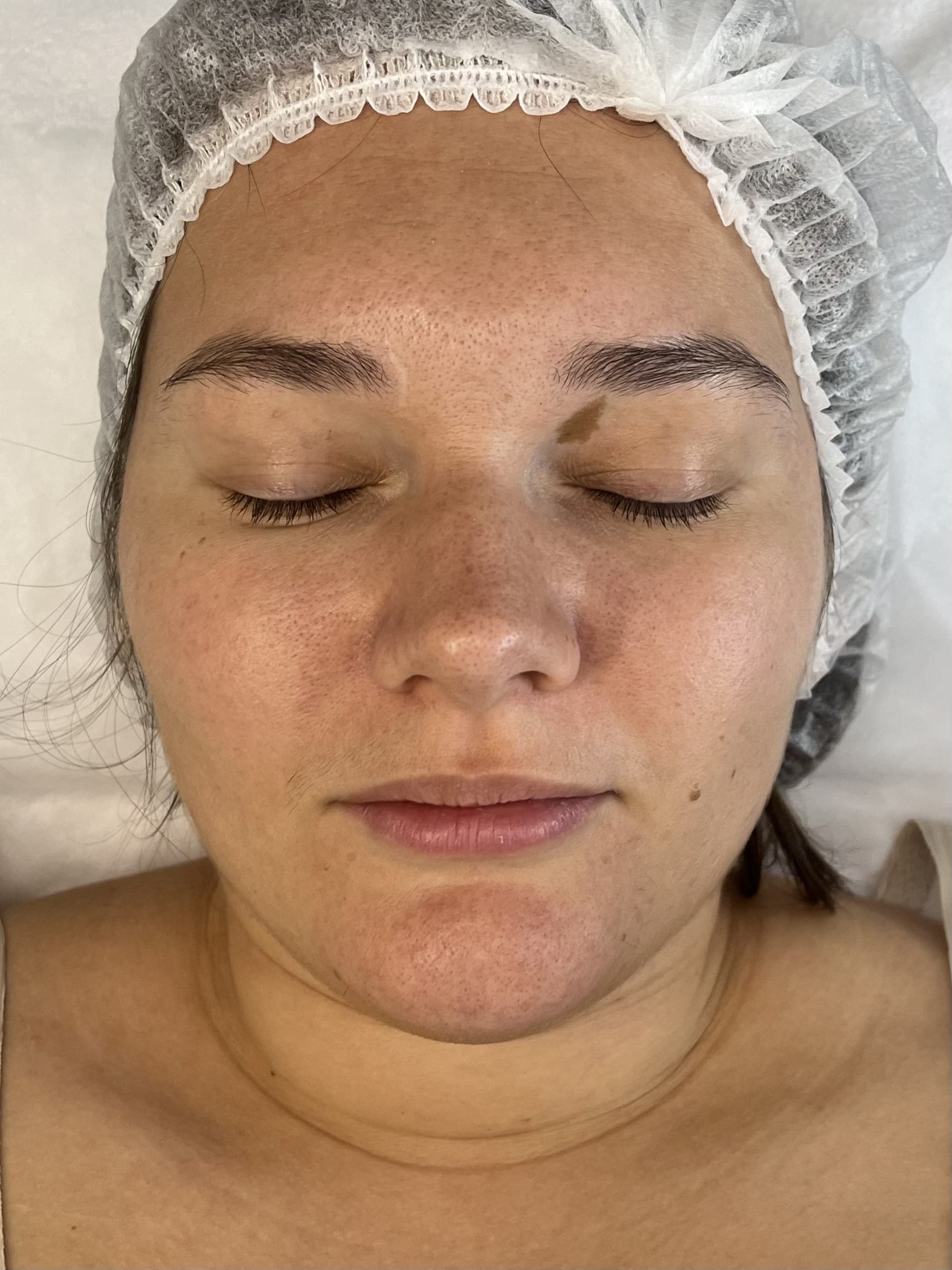 Before post-winter reset seasonal facial treatment