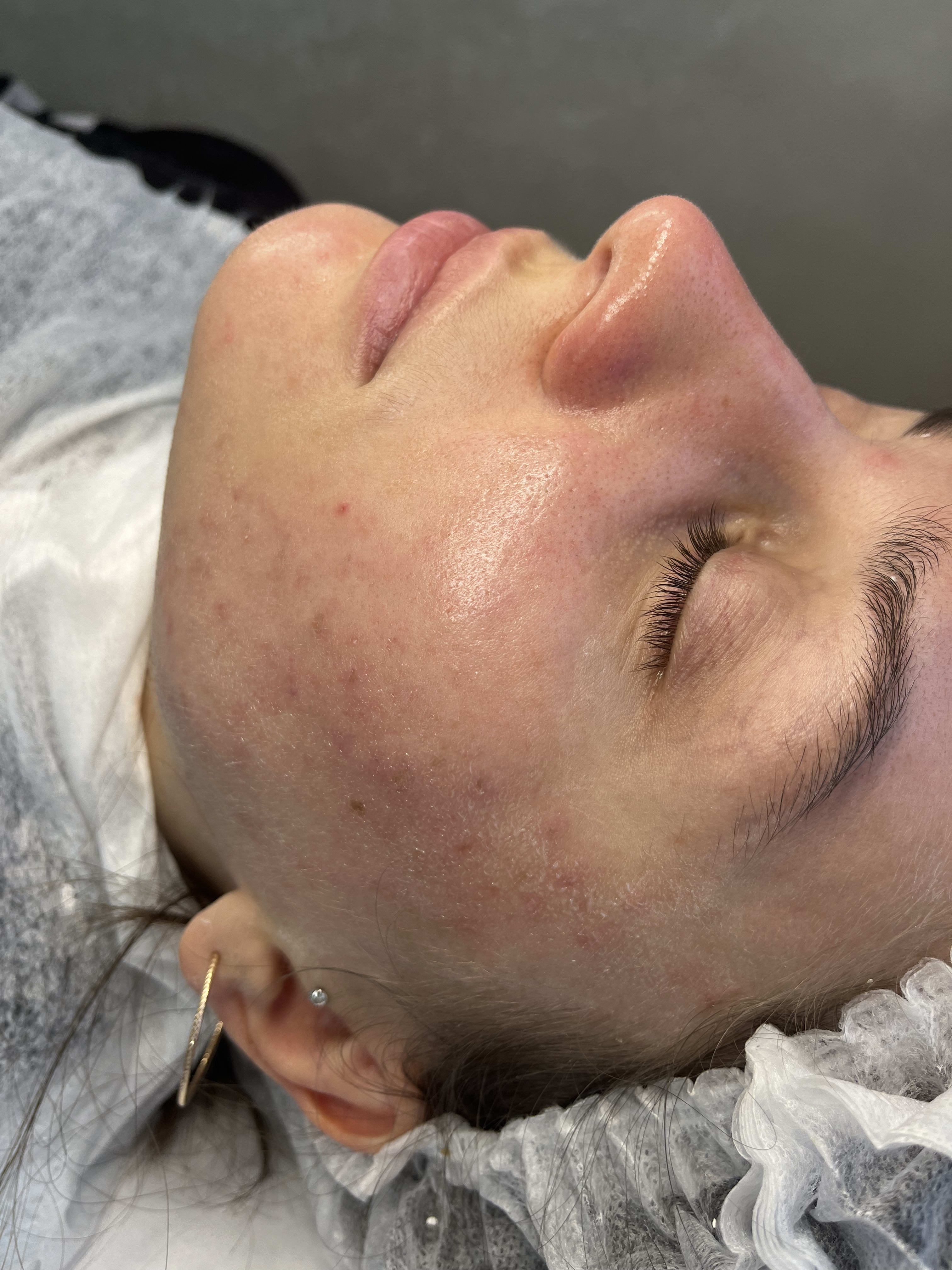 After extraction protocol showing cleared pores and balanced skin