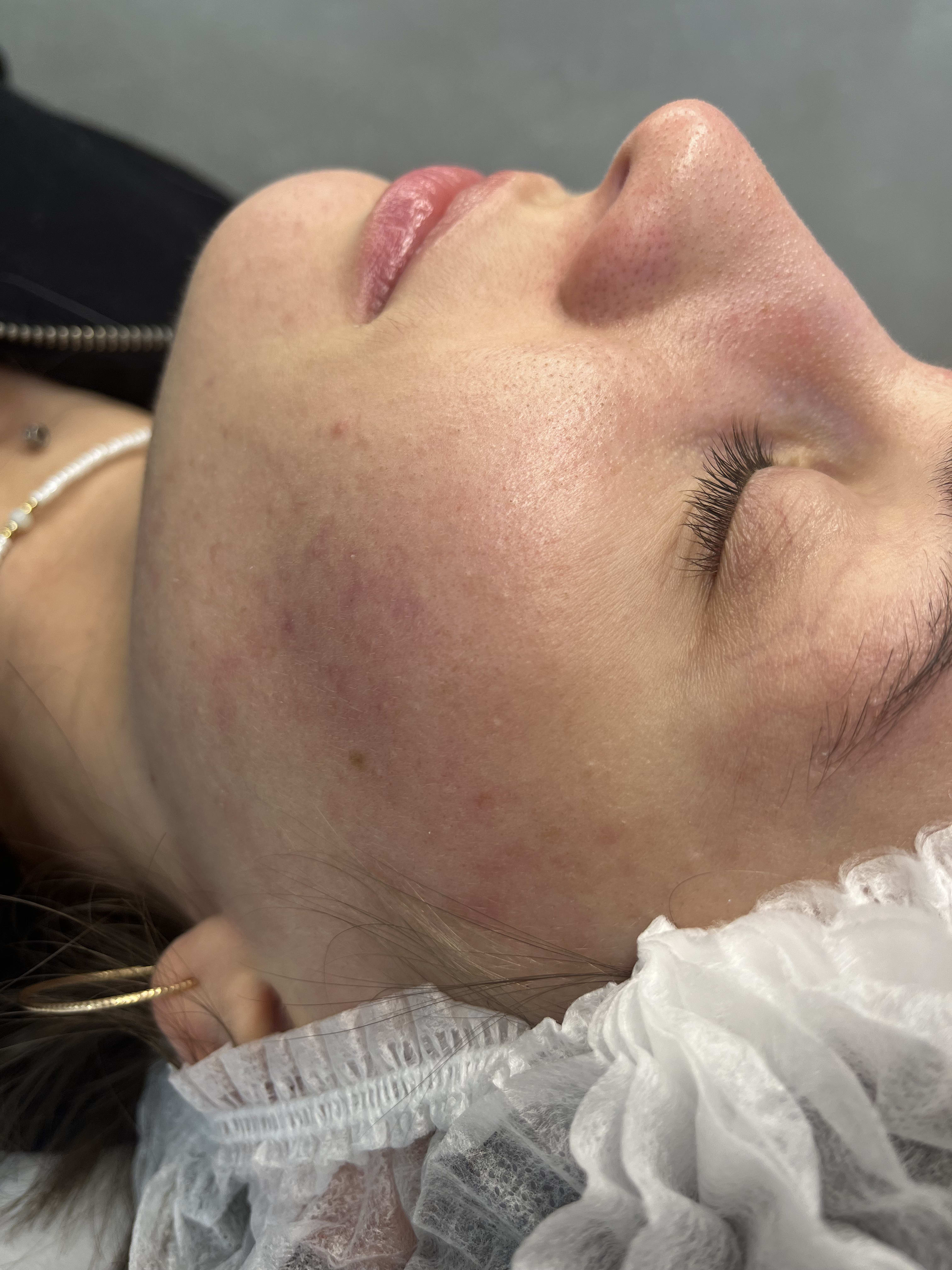 Before extraction protocol showing clogged pores and skin congestion