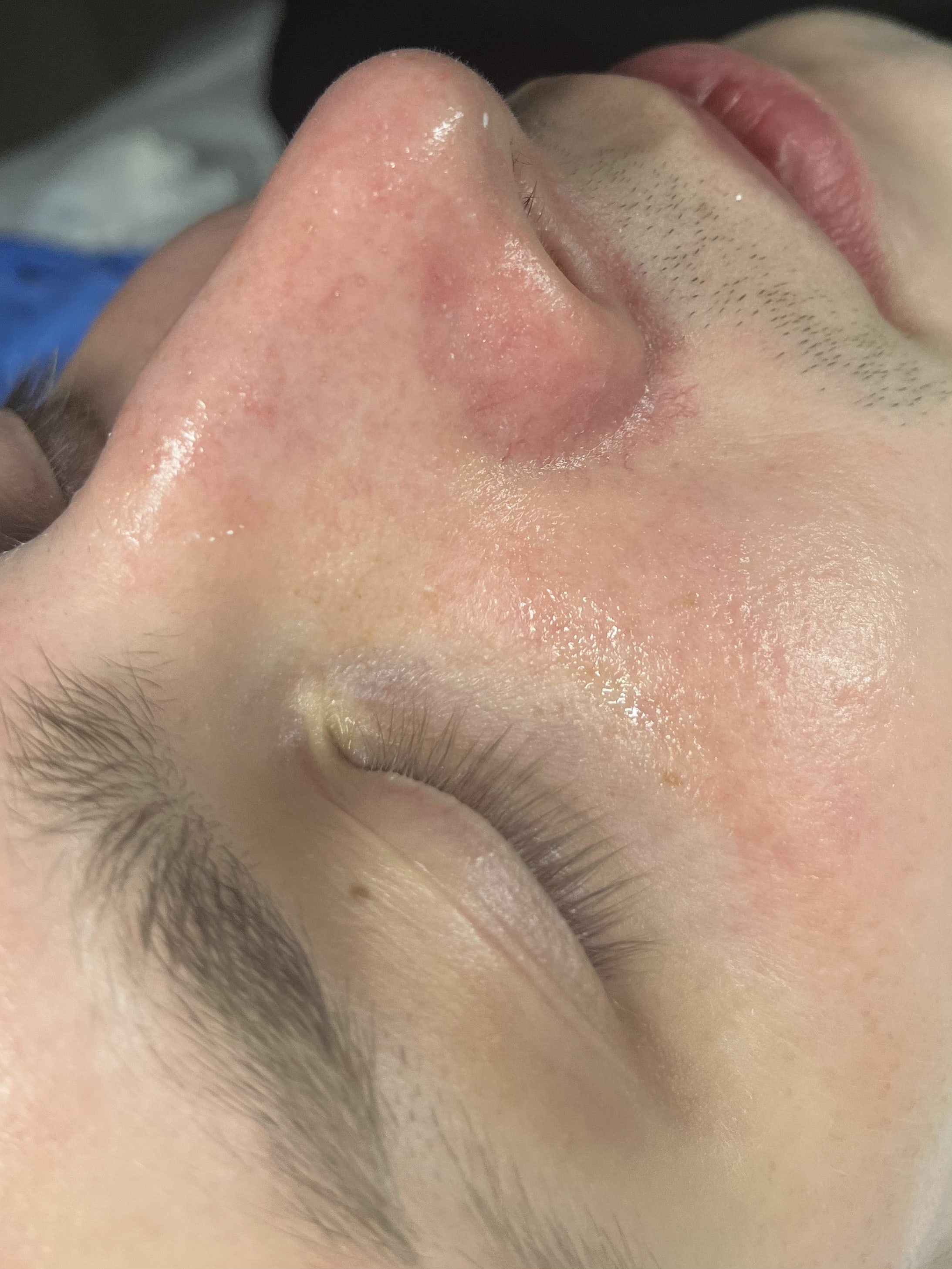 After extraction protocol showing cleared pores and balanced skin