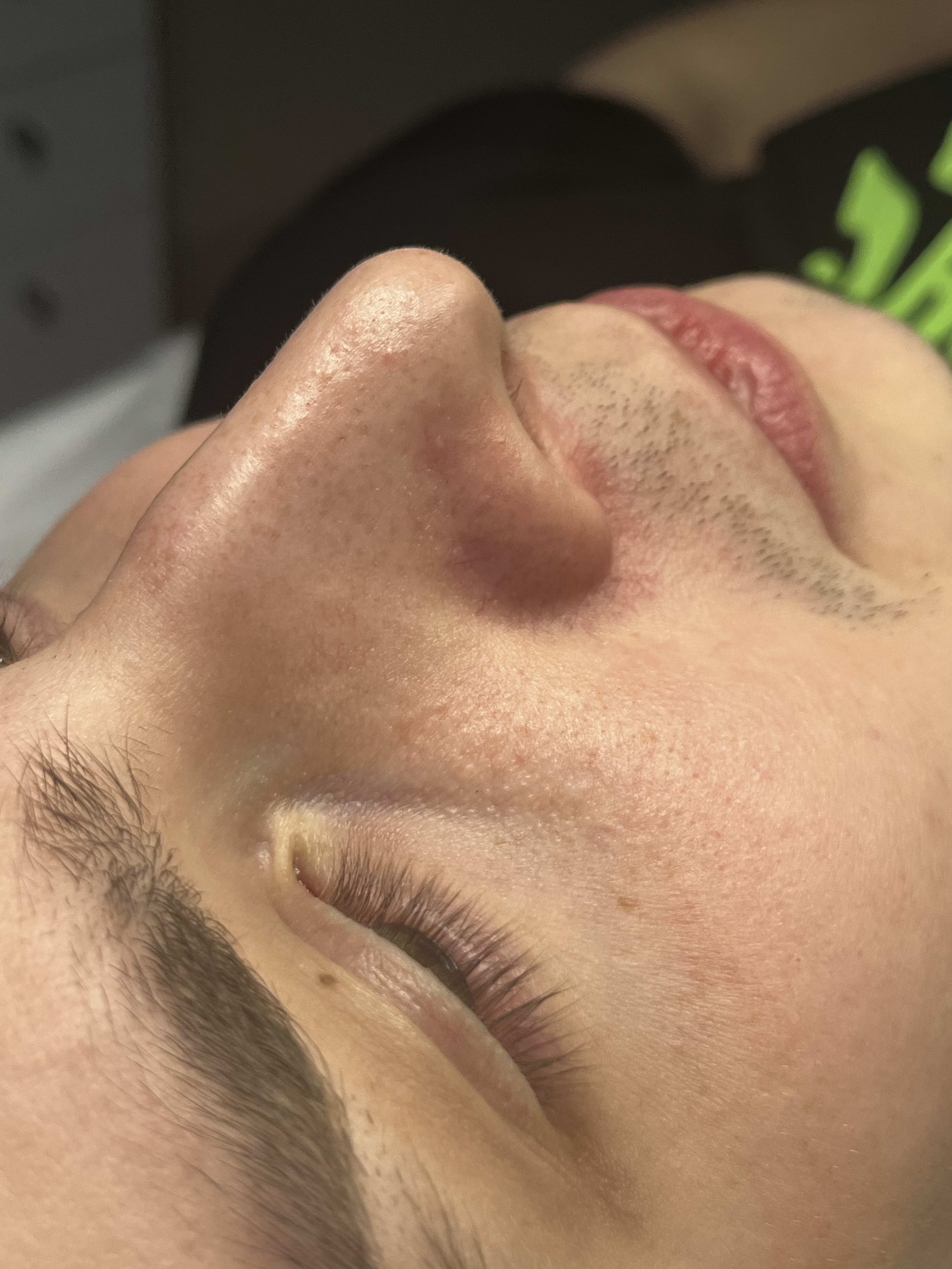 Before extraction protocol showing clogged pores and skin congestion