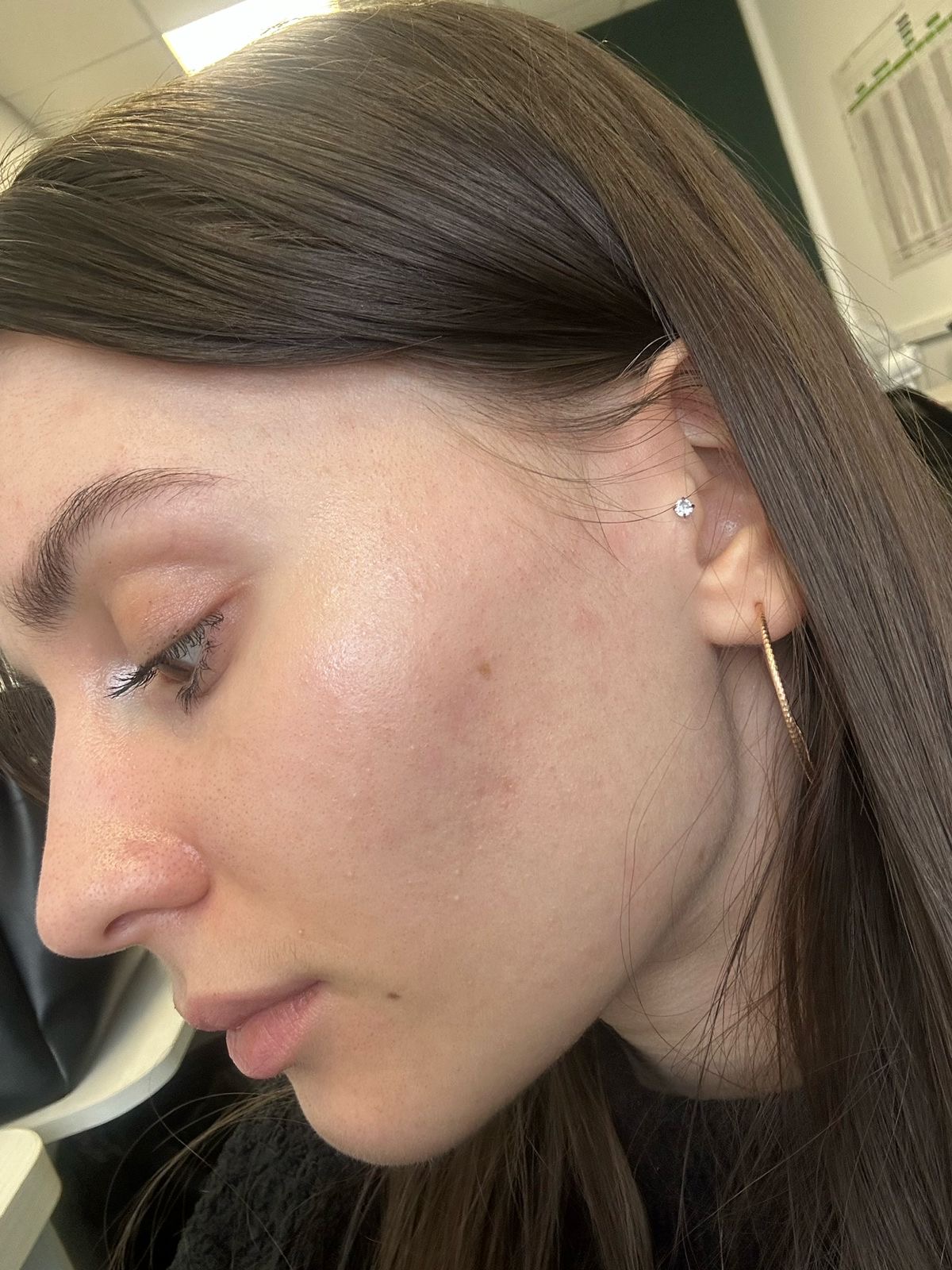 After reset protocol and home skincare routine showing lasting skin improvement