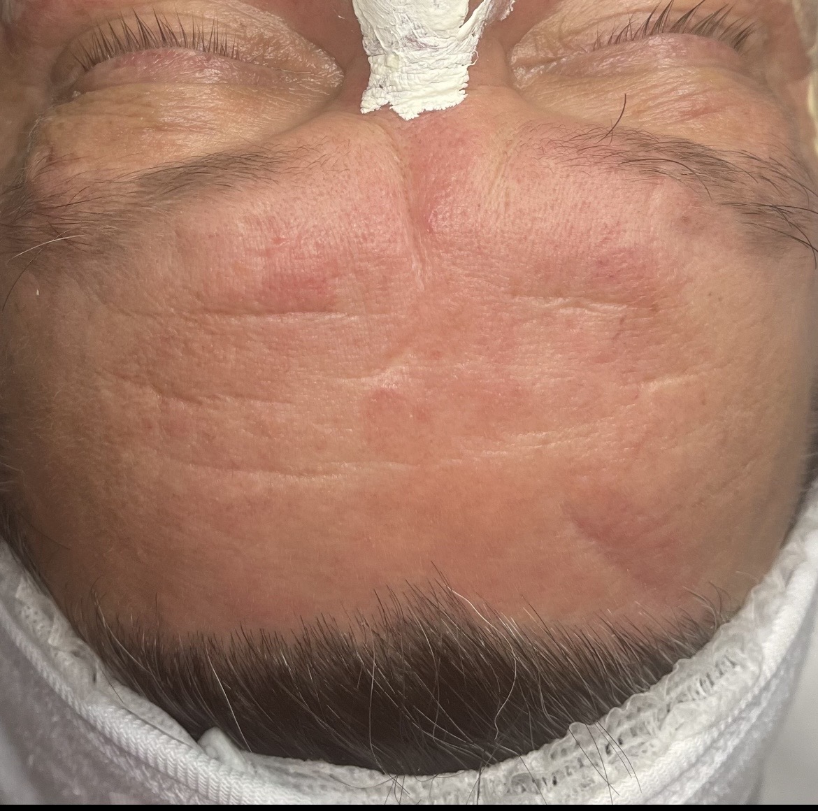 After microneedling treatment showing faded marks and smoother skin texture