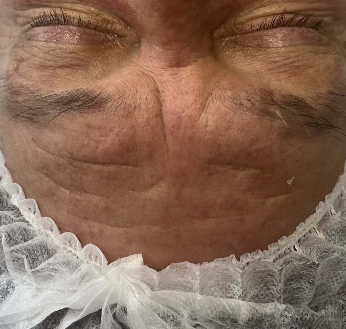 Before microneedling treatment showing acne marks and uneven texture