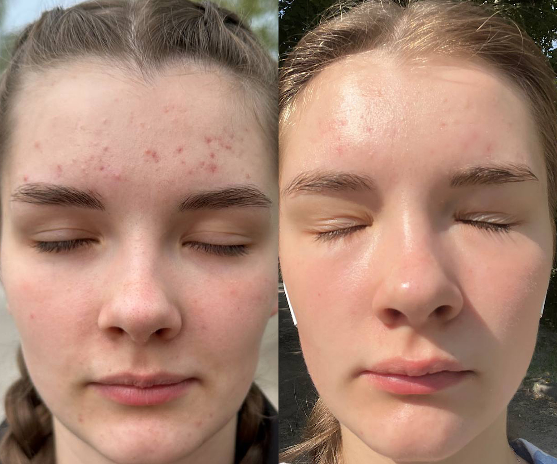 Personalized facial with home routine before and after showing progressive skin improvement