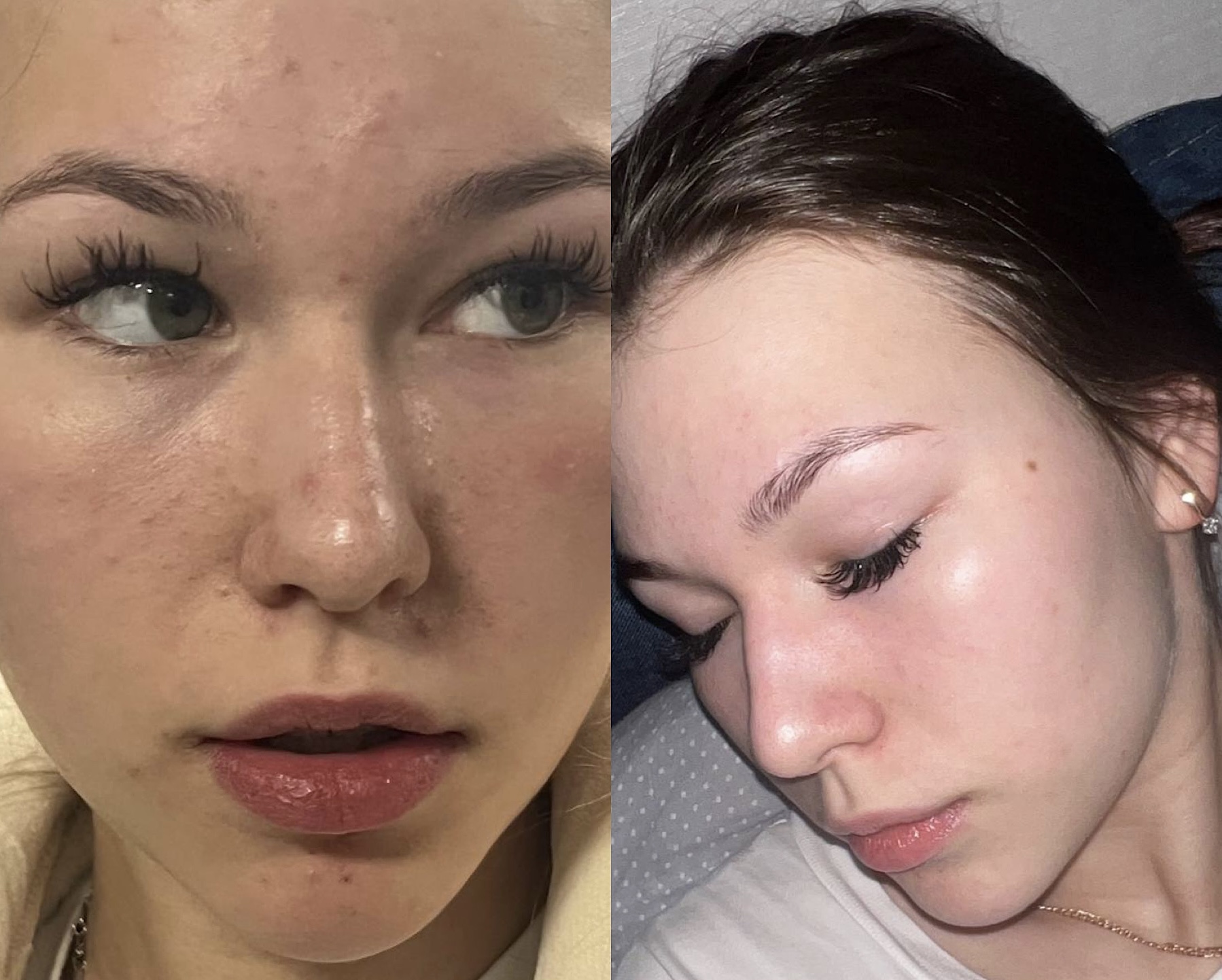 Personalized facial with home routine before and after showing progressive skin improvement