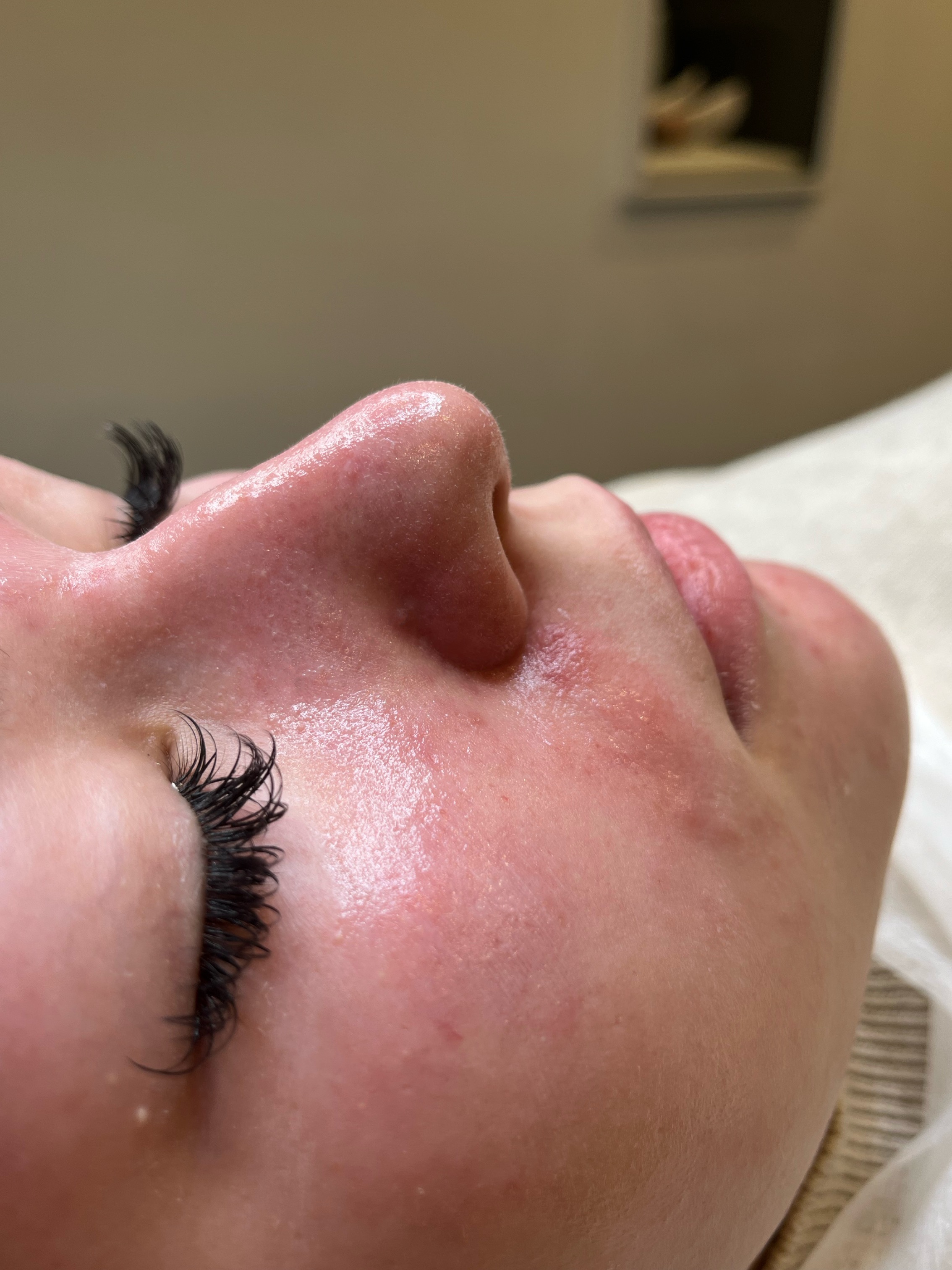 After extraction protocol showing cleared pores and balanced skin