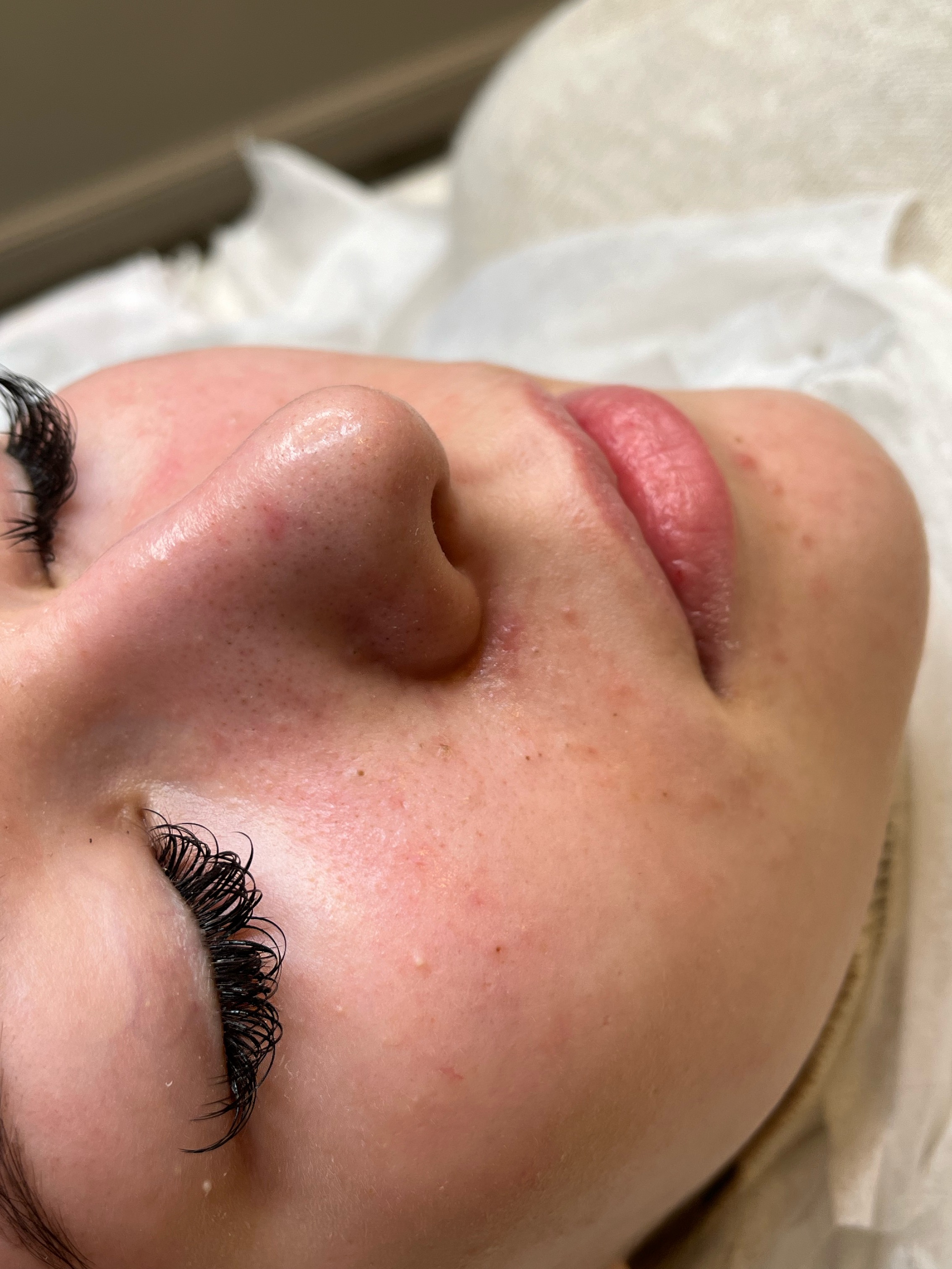 Before extraction protocol showing clogged pores and skin congestion