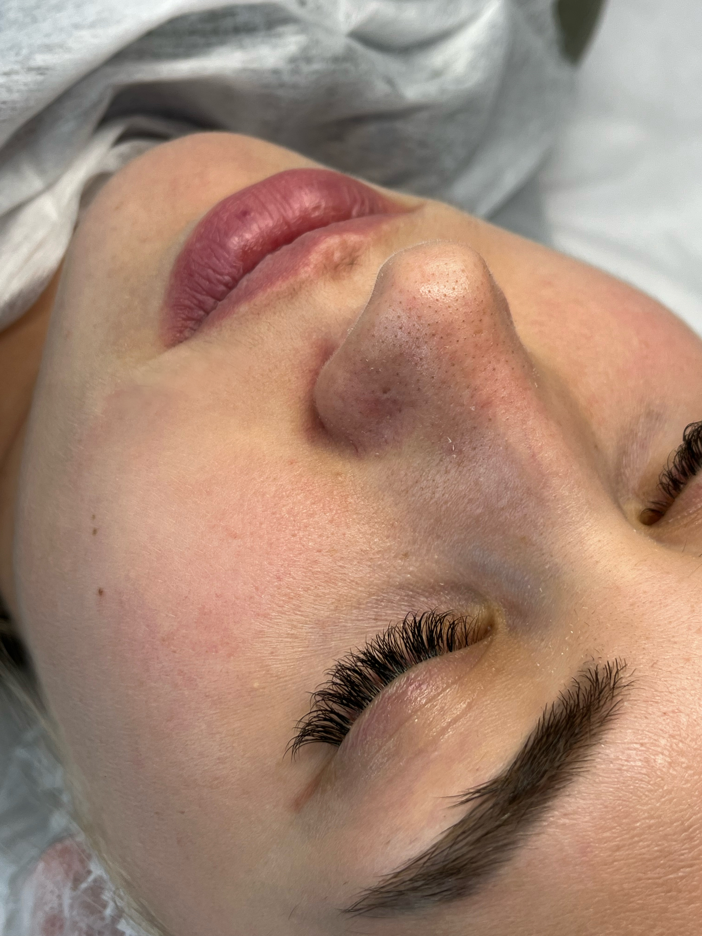 Before extraction protocol showing clogged pores and skin congestion