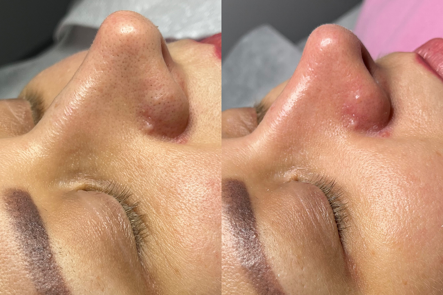 Extraction facial before and after comparison showing cleared congestion and smoother skin
