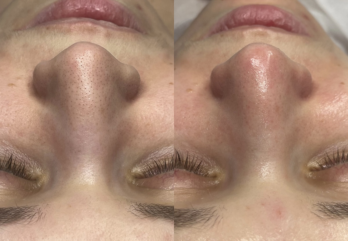 Extraction facial before and after comparison showing cleared congestion and smoother skin