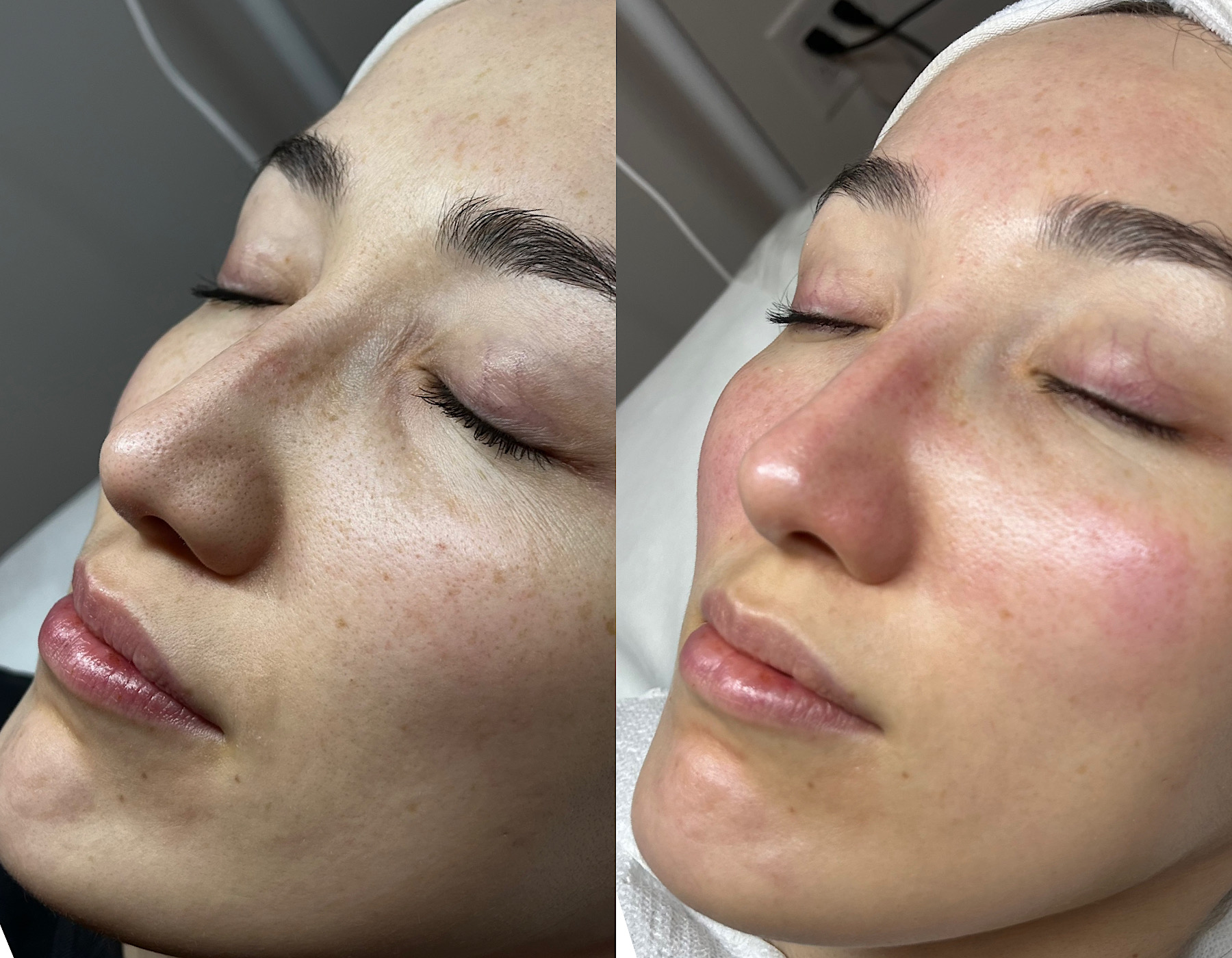 Personalized facial before and after comparison showing improved skin clarity