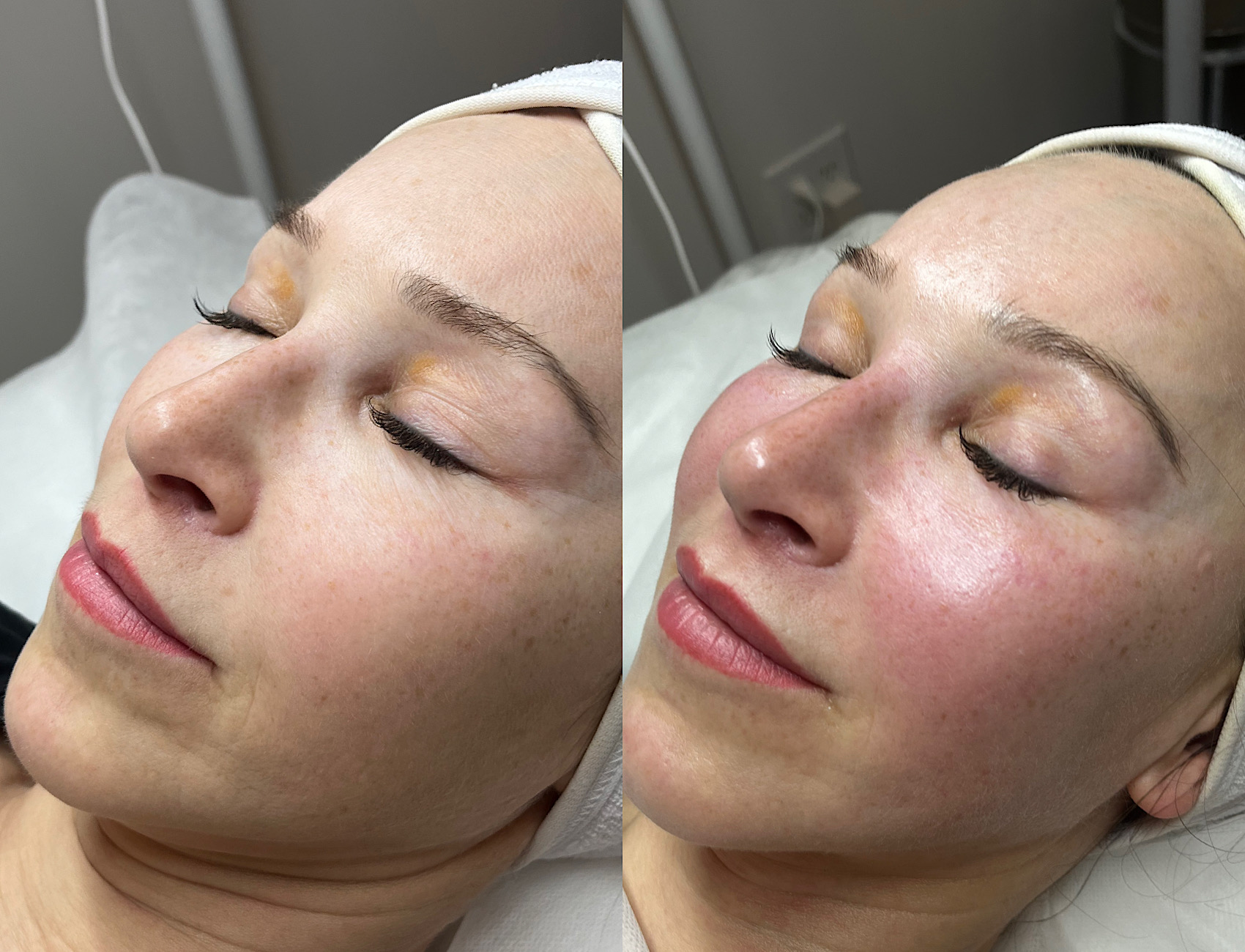 Spring bloom facial before and after comparison showing restored hydration and glow